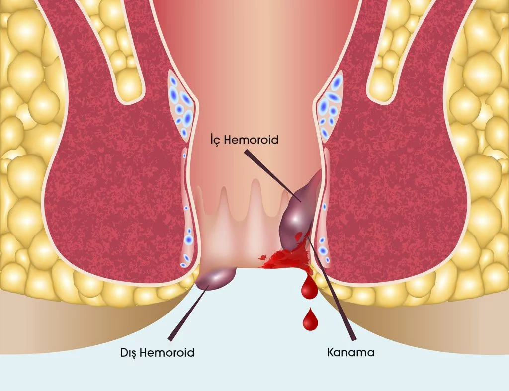 Hemoroid Nedir?