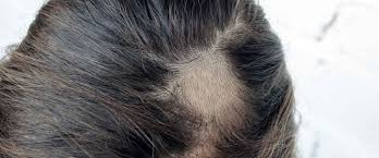 Alopesi Areata Tedavisi