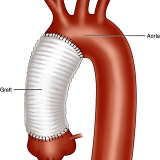 Arkus Aorta Anevrizmasının Belirtileri