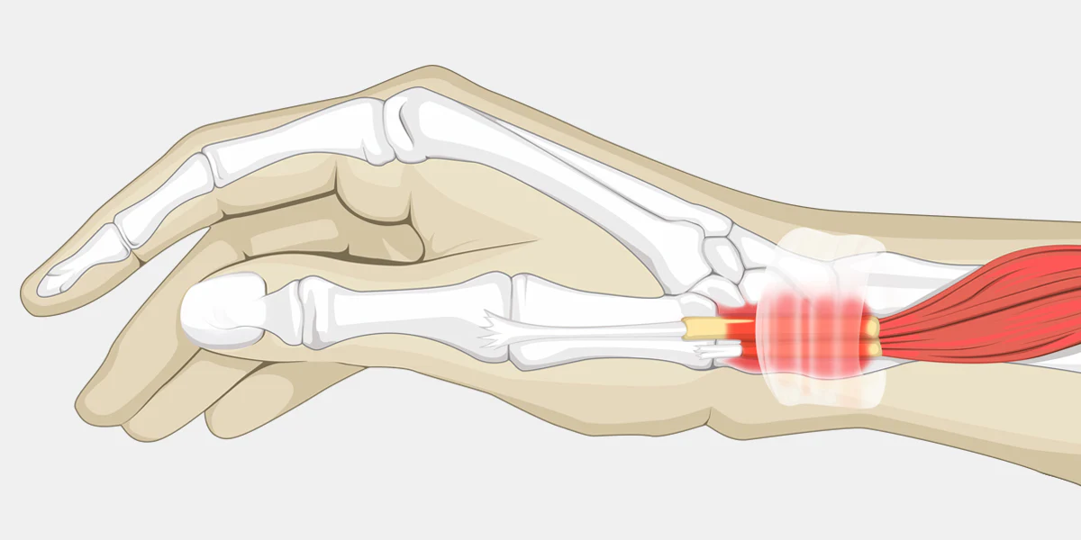 De Quervain Tenosinoviti Sebepleri