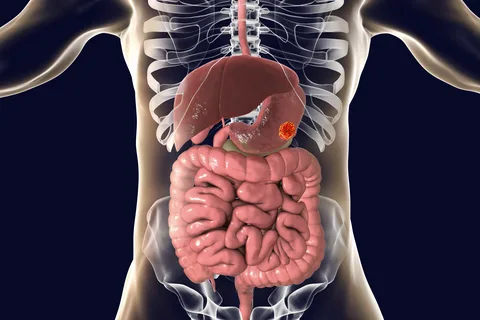 Gastrointestinal Sistem Kanserlerinin Sebepleri