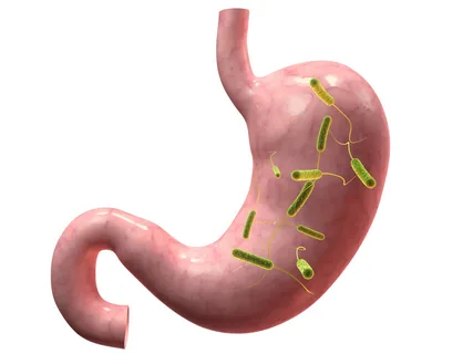 Gastroparezi (Mide Felci) Tedavisi