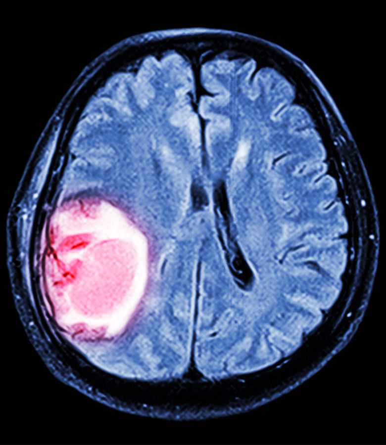 Glial Tümör Tedavisi